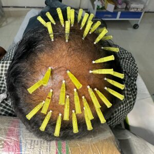 Best Hair Transplant Treatment by Royal Derma