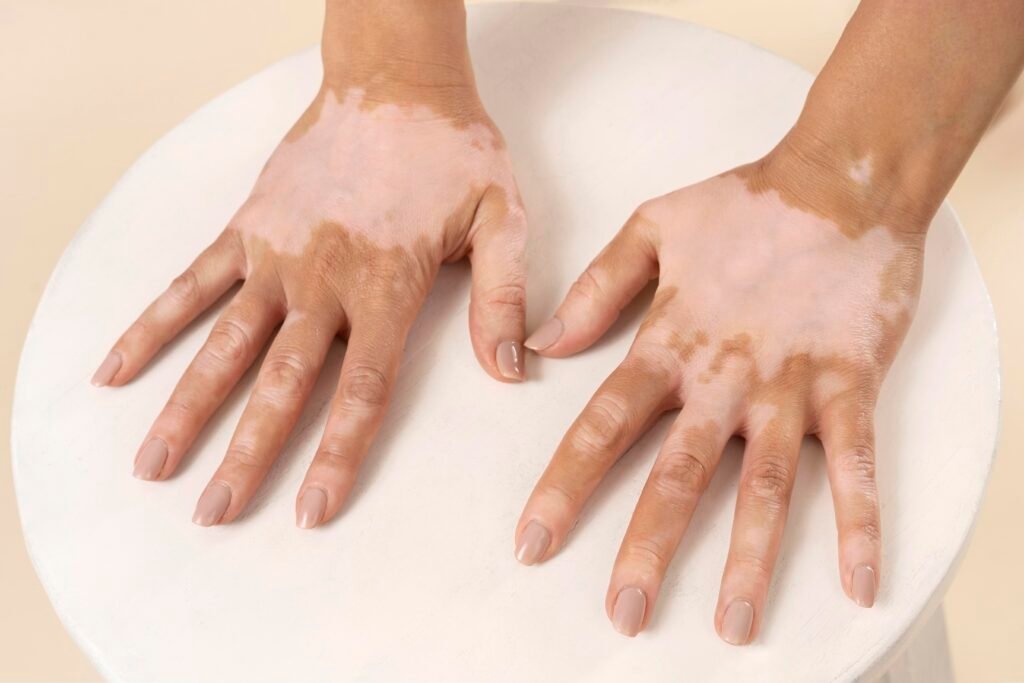 vitiligo treatment