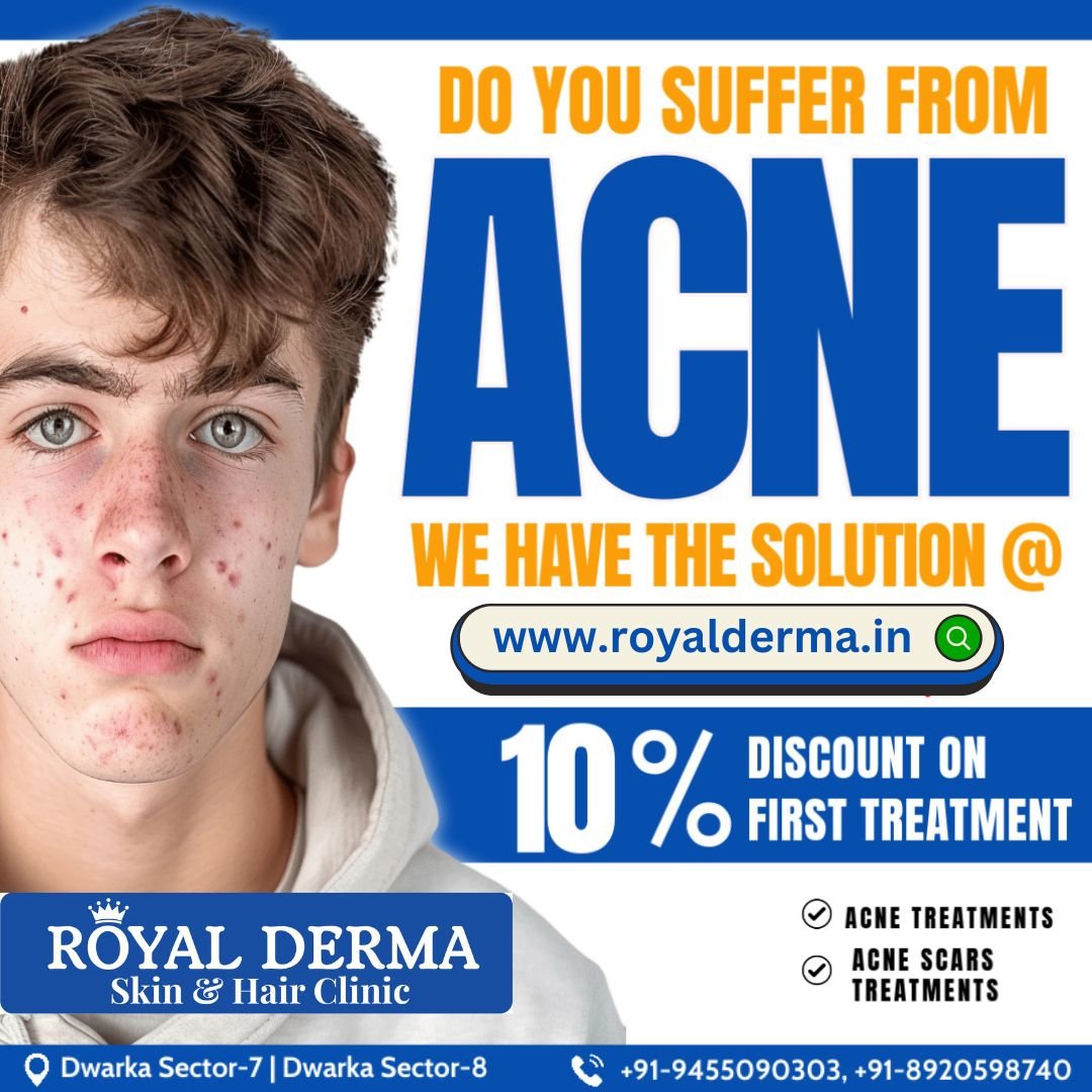 Best Acne Treatment in Dwarka, Delhi.