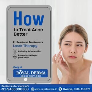 Best clinic for acne treatment in Dwarka, Delhi.