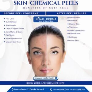 Chemical Peel Treatment in Dwarka, Delhi