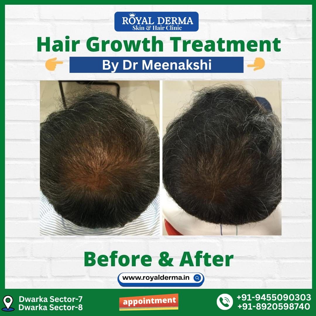 Hair Growth Treatment in Dwarka, Delhi.