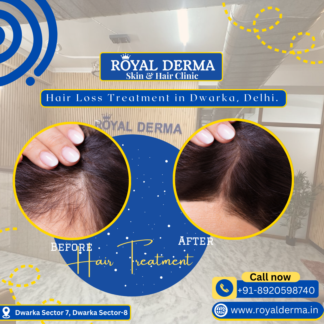 Hair Loss Treatment in Dwarka, Delhi.