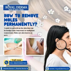 How to remove moles permanently