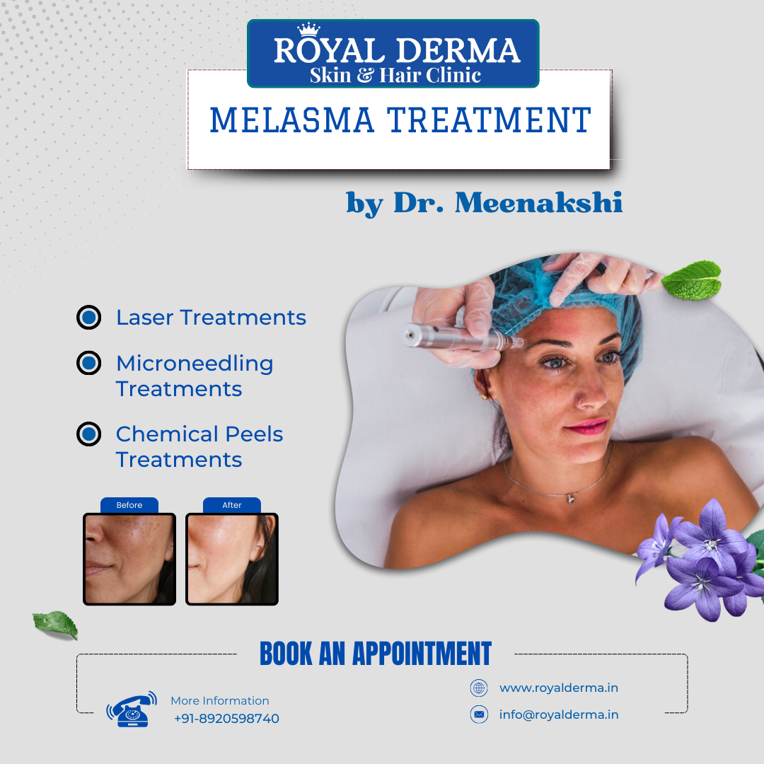 Most effective treatment for melasma