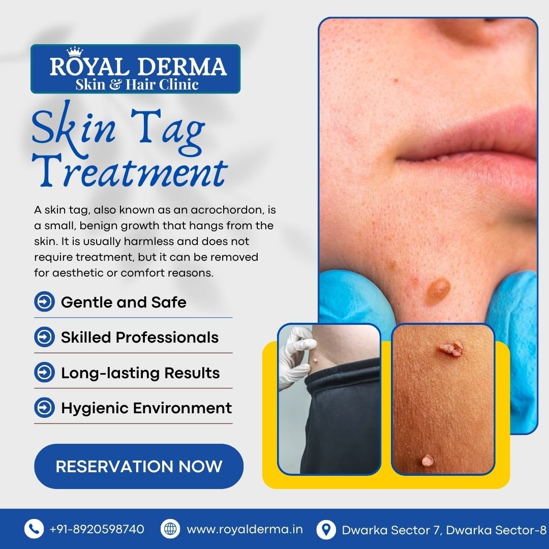 Skin Tag Treatment by Dr. Meenakshi