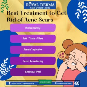 Best Treatment to Get Rid of Acne Scars