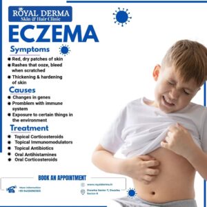 ECZEMA Symptoms, Causes, Treatment