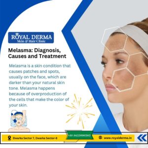 Melasma Diagnosis ,Causes and Treatment