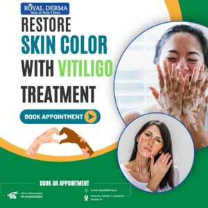 Restore skin color with Vitiligo Treatment