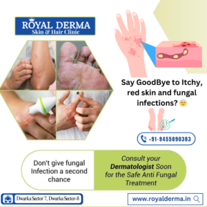 Say GoodBye to Itchy, red skin and fungal infections