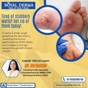 Tired of stubborn warts Get rid of them today!