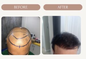 Hair transplant by royal derma skin clinic