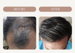 Cost of Hair Transplant