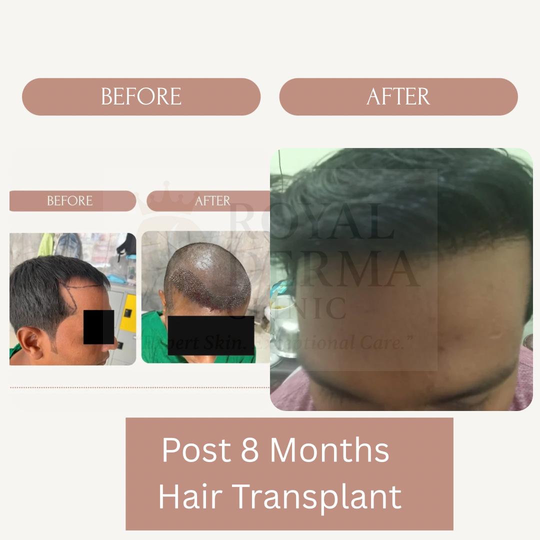 Hair transplant before and after results at Royal Derma Skin Clinic
