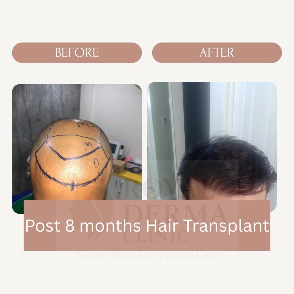 Best clinic for hair transplant