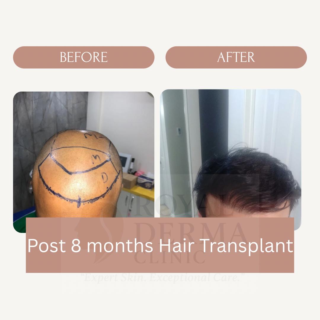 Hair transplant before and after results at Royal Derma Skin Clinic Dwarka Delhi