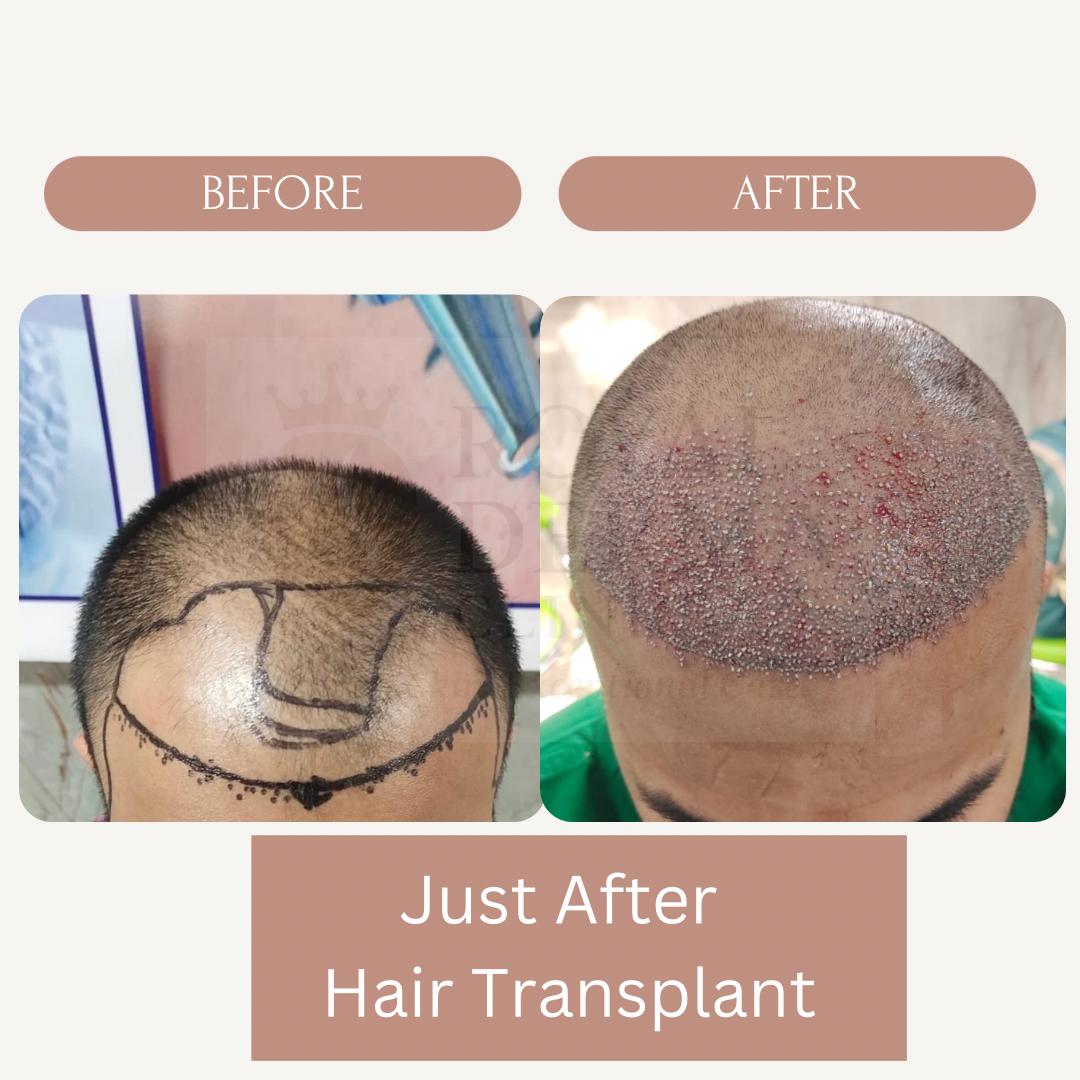 Hair transplant before and after results at Royal Derma Skin Clinic Dwarka Delhi