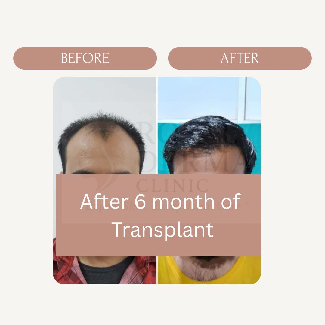Hair transplant before and after results at Royal Derma Skin Clinic