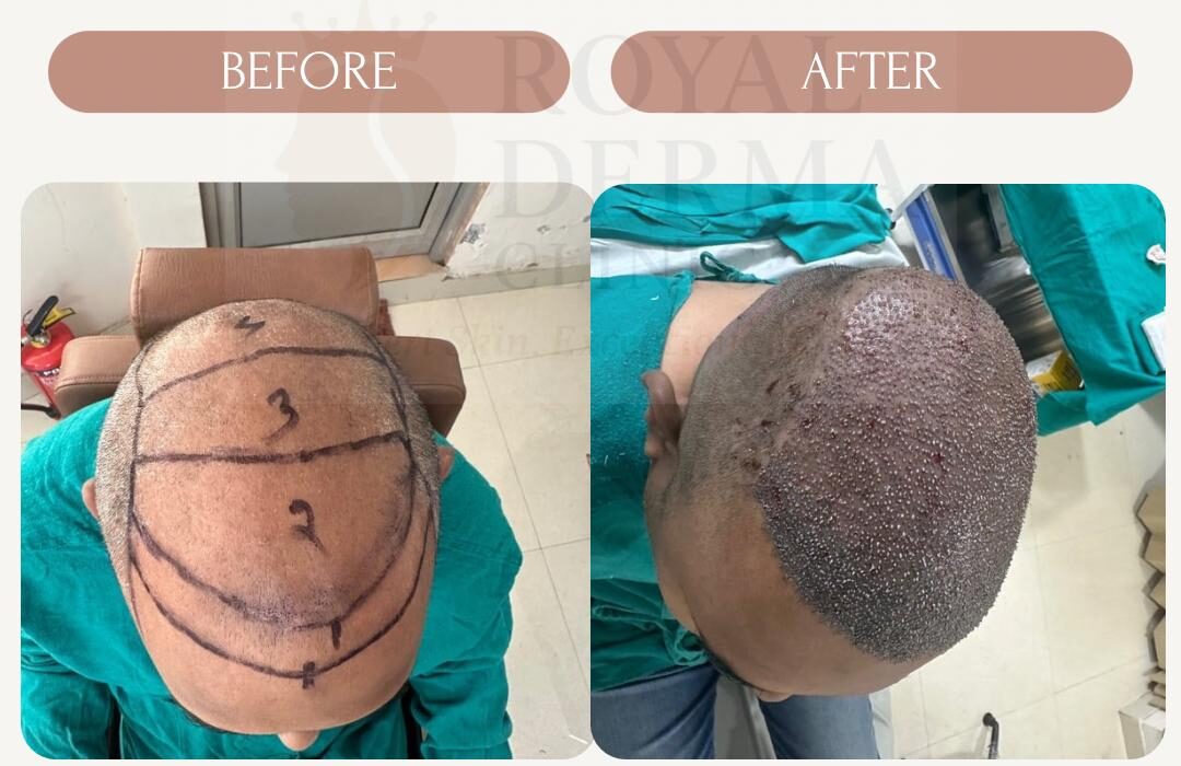 Hair transplant before and after results at Royal Derma Skin Clinic Dwarka Delhi