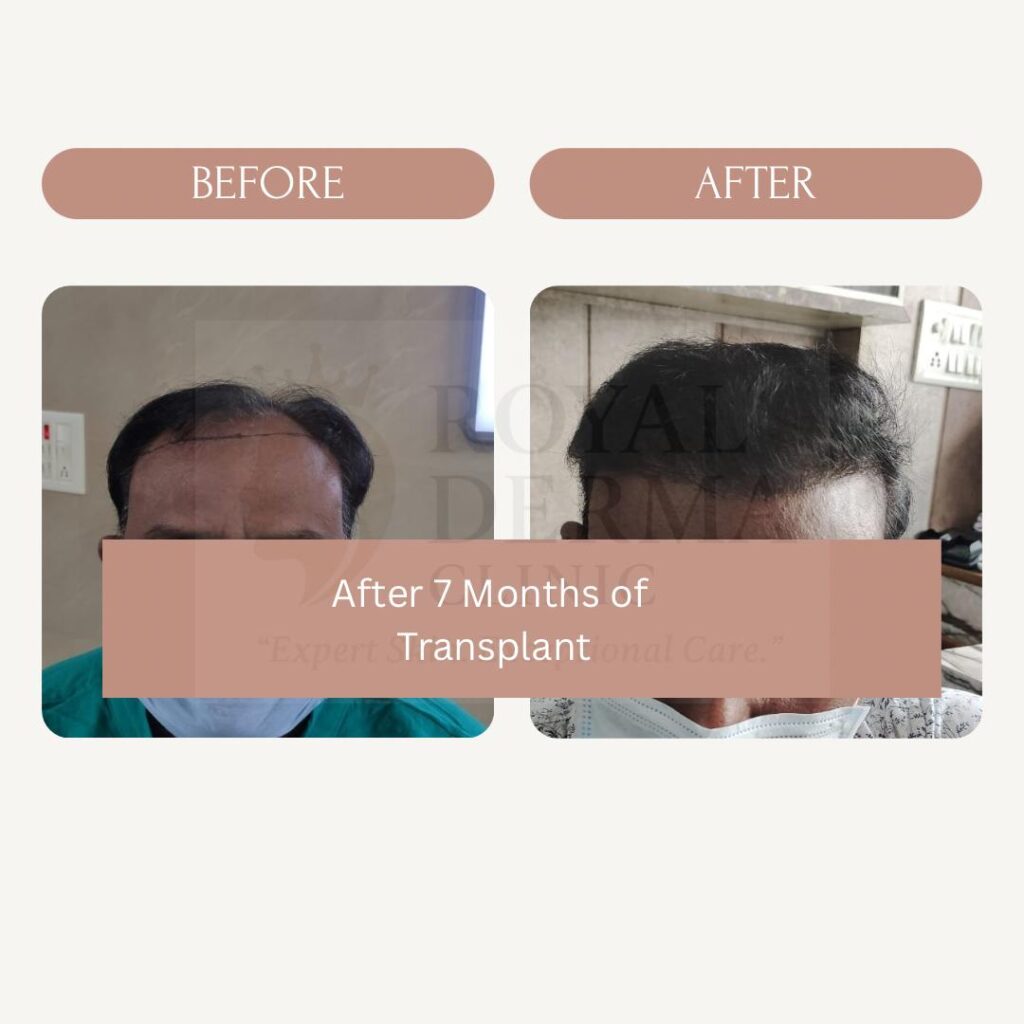 Hair Transplant in Delhi