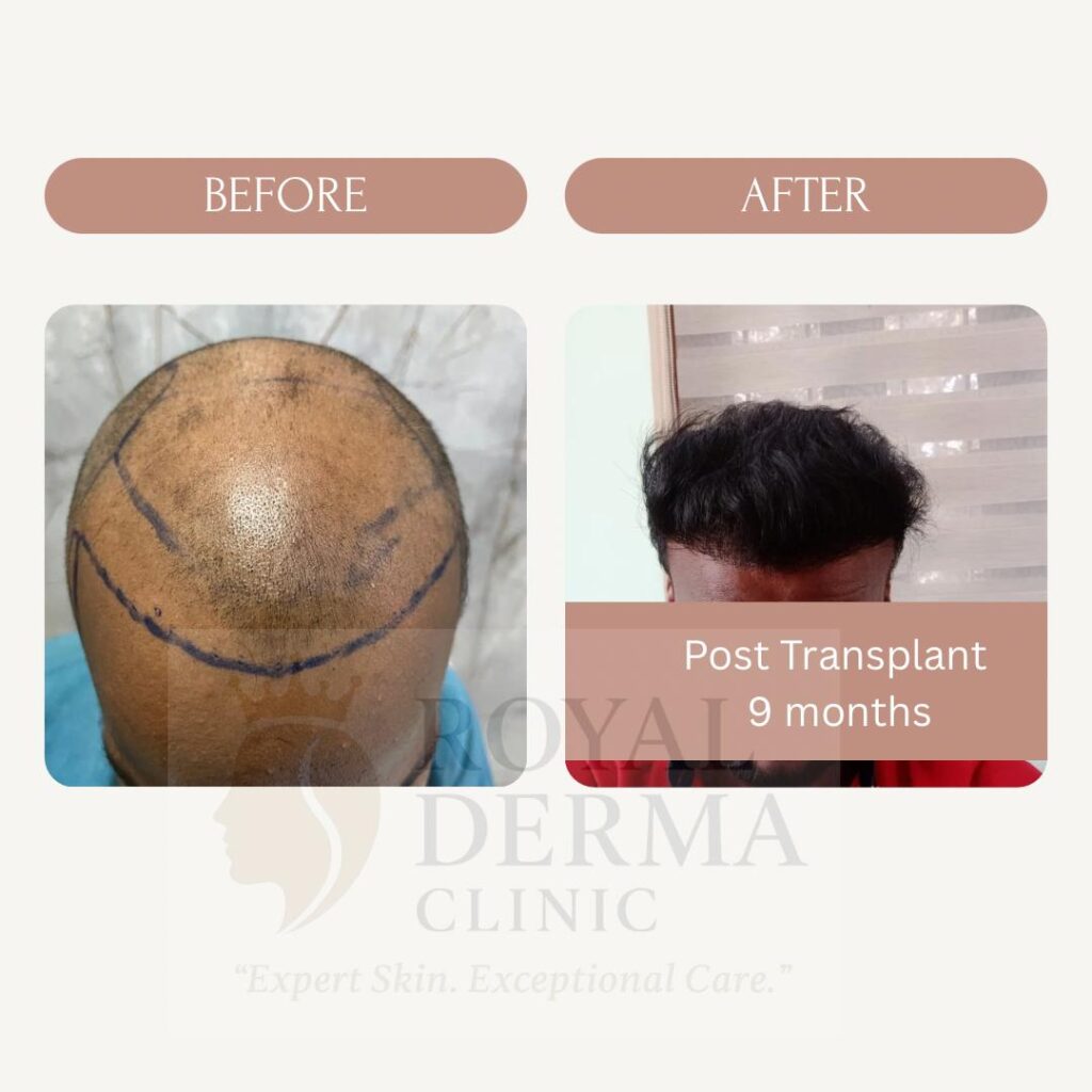 Top Hair Transplant Clinics in Dwarka, Delhi
