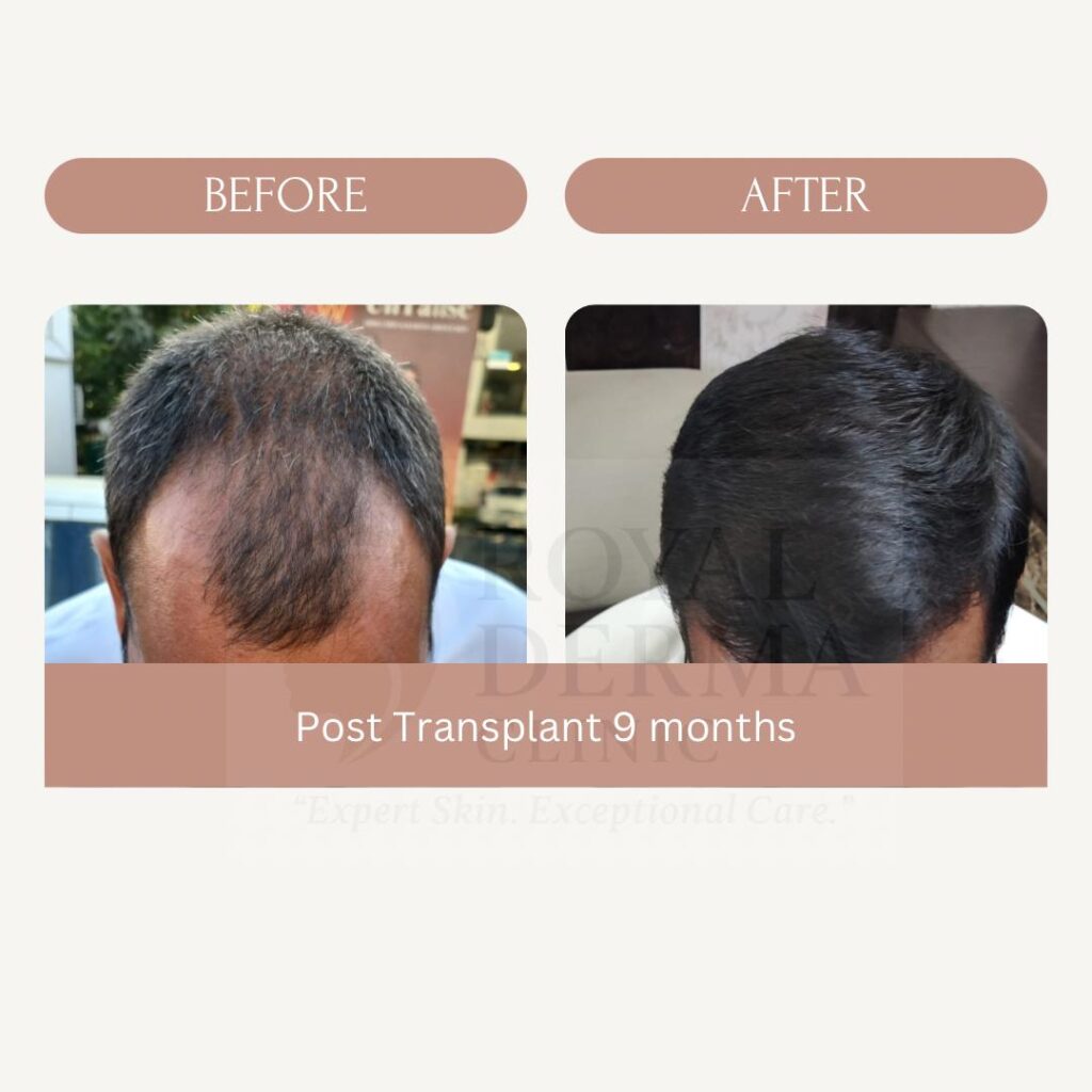 Hair transplant near me