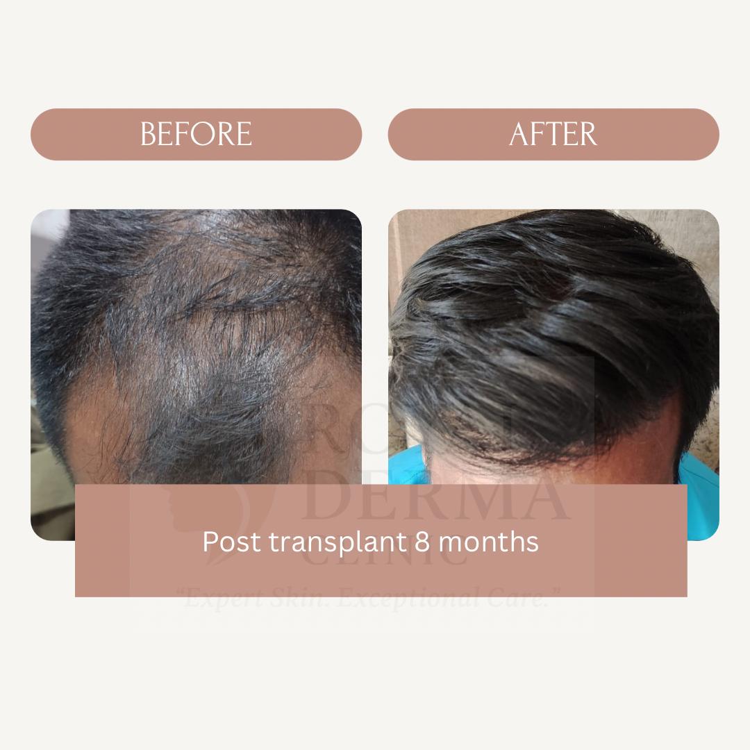 Hair transplant before and after results at Royal Derma Skin Clinic