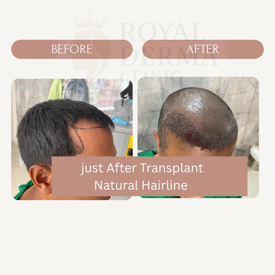 Hair transplant before and after results at Royal Derma Skin Clinic