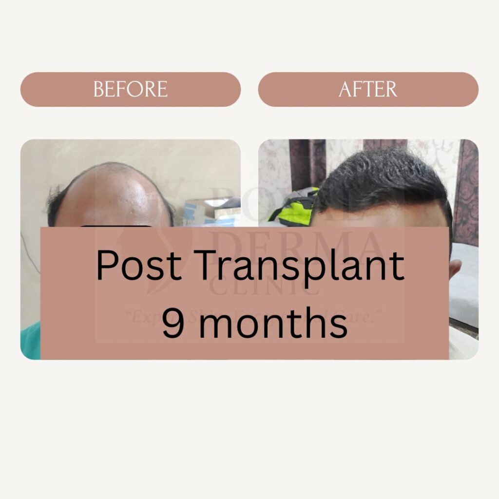 Top Hair Transplant Clinics in Dwarka, Delhi