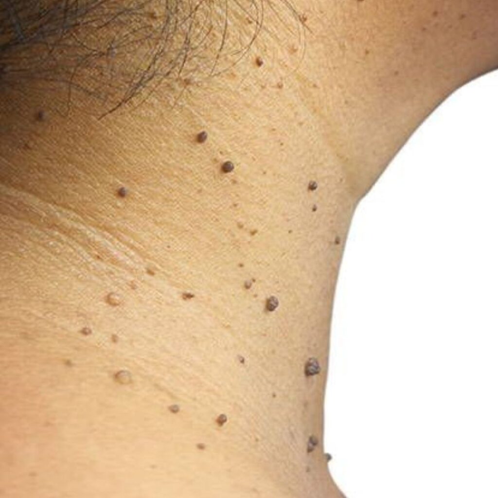 Skin Tags Treatment