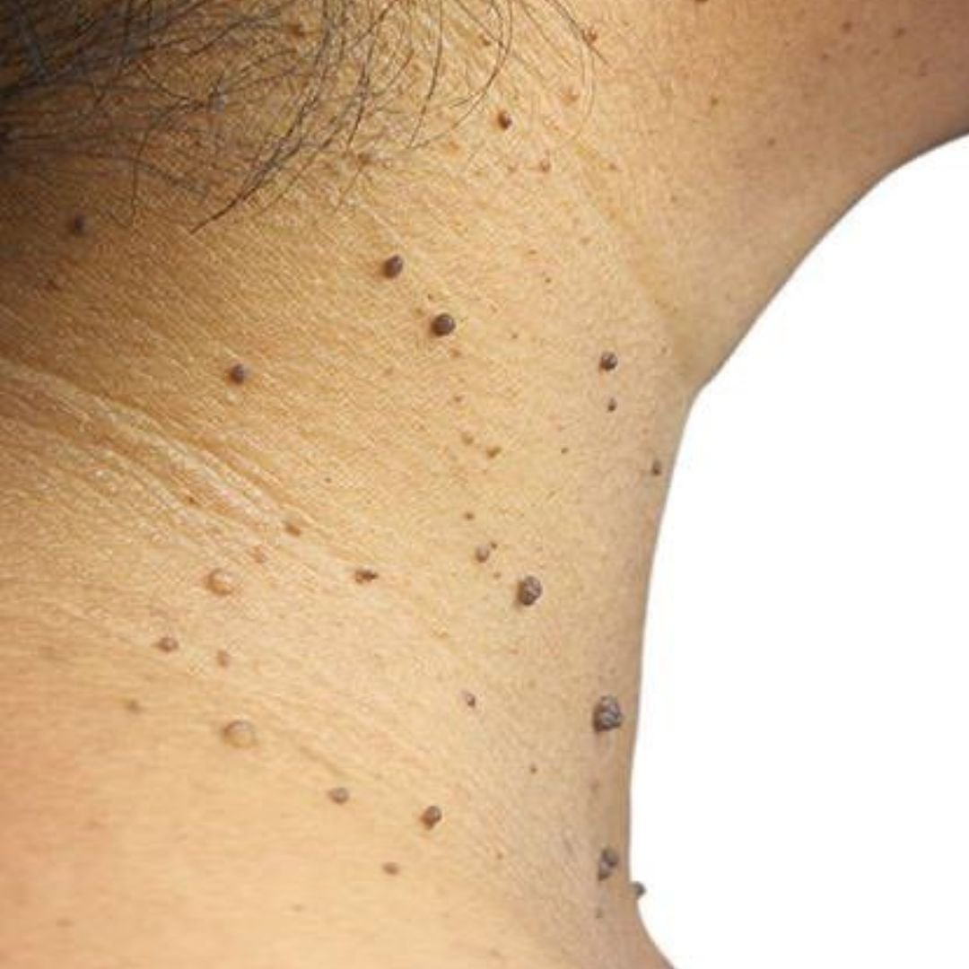 Skin Tags Treatment by Royal Derma