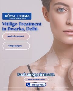 Vitiligo Treatment in Dwarka, Delhi.