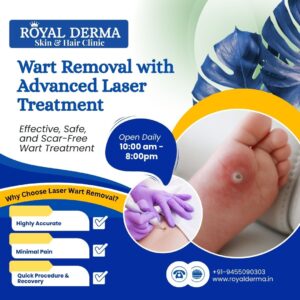 Wart Removal with Advanced Laser Treatment