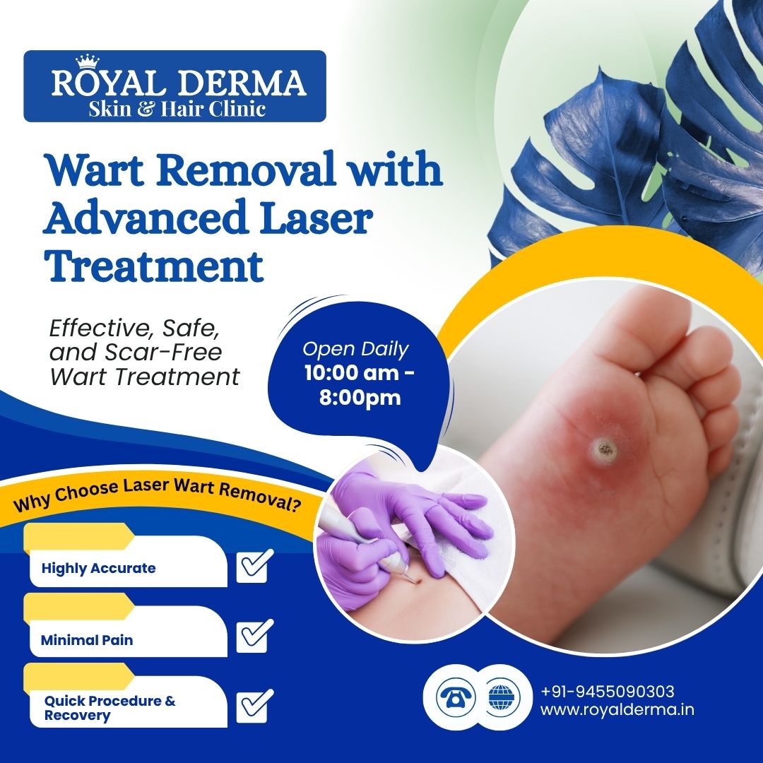 Wart Removal with Advanced Laser Treatment