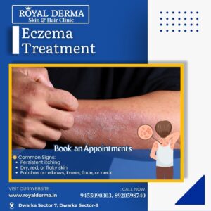 Eczema Treatment in Dwarka, Delhi