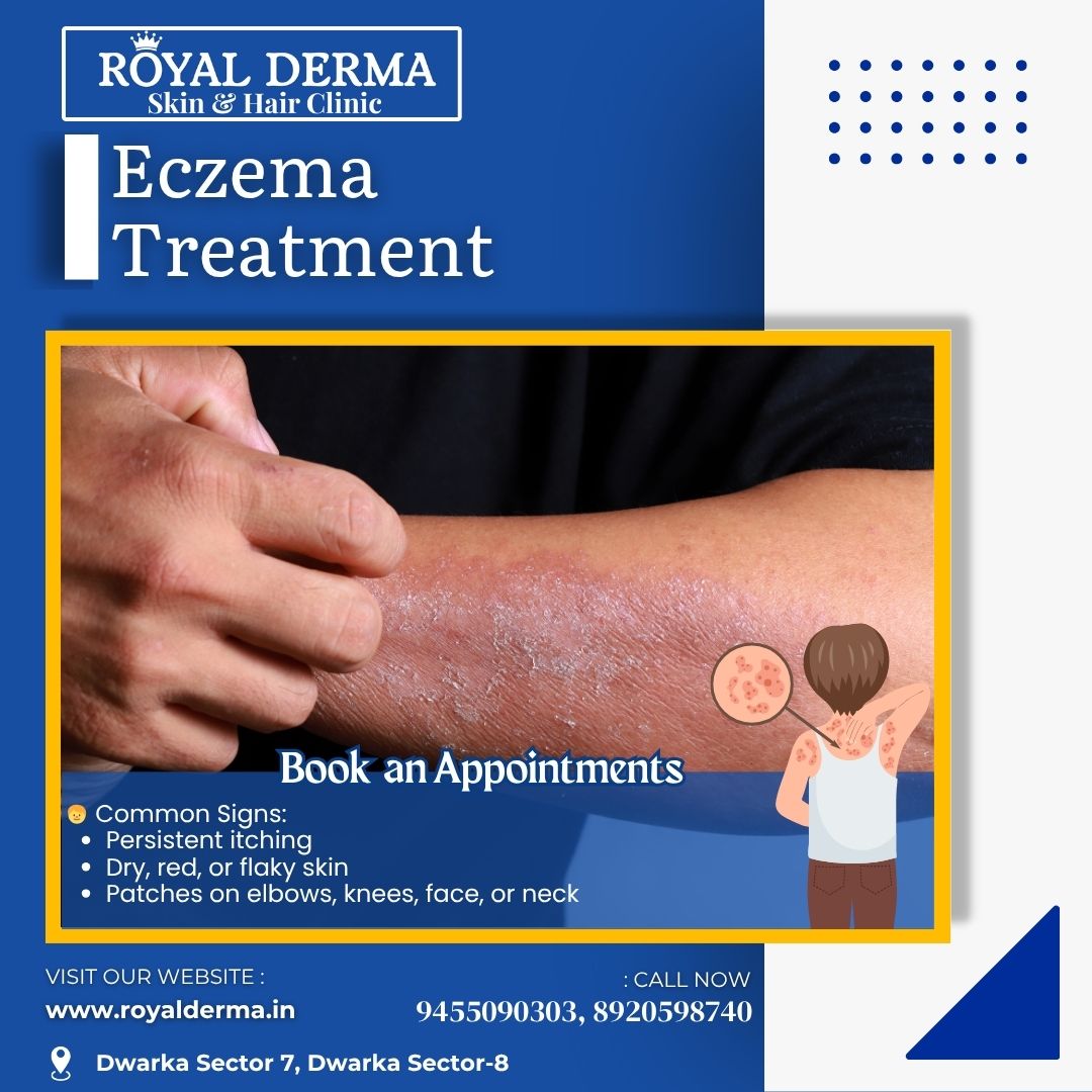 Eczema Treatment in Dwarka, Delhi