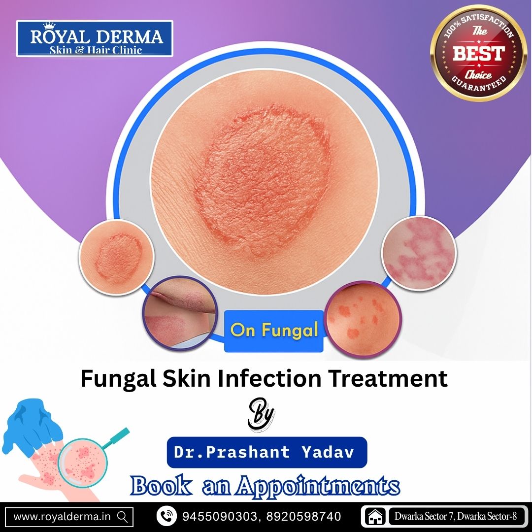 Fungal Skin Infection Treatment in Delhi