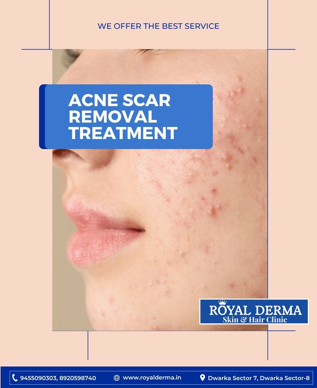 Best Acne Scar Removal Treatment