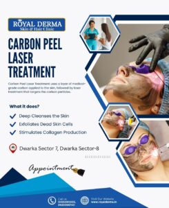 Carbon Peel Laser Treatment