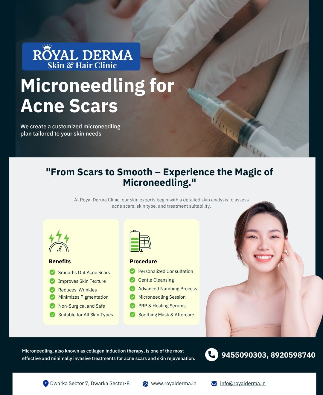Microneedling for Acne Scars