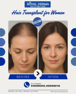 Hair Transplant for Women