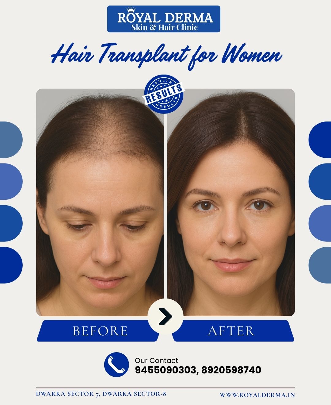 Hair Transplant for Women