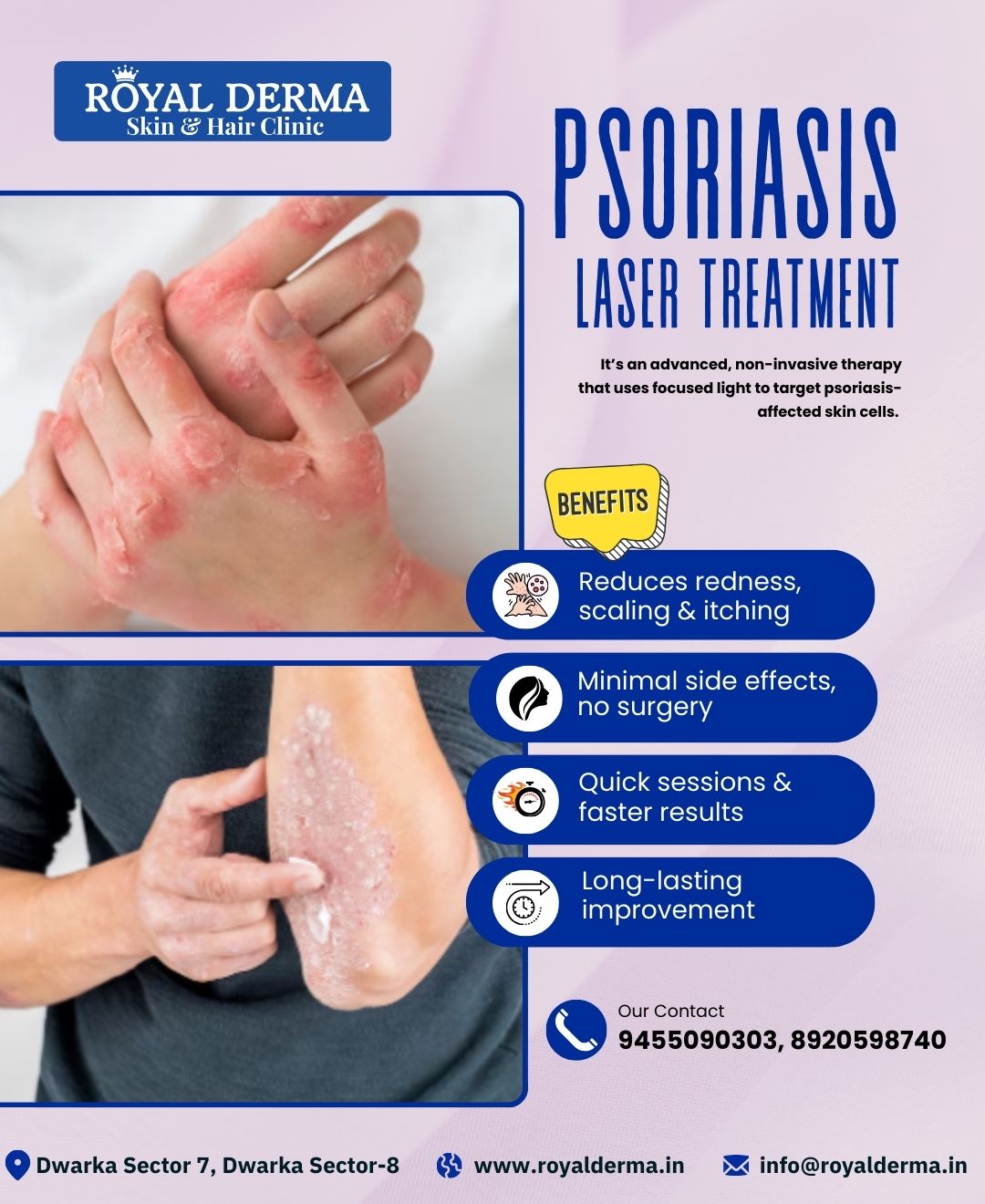 Psoriasis Laser Treatment