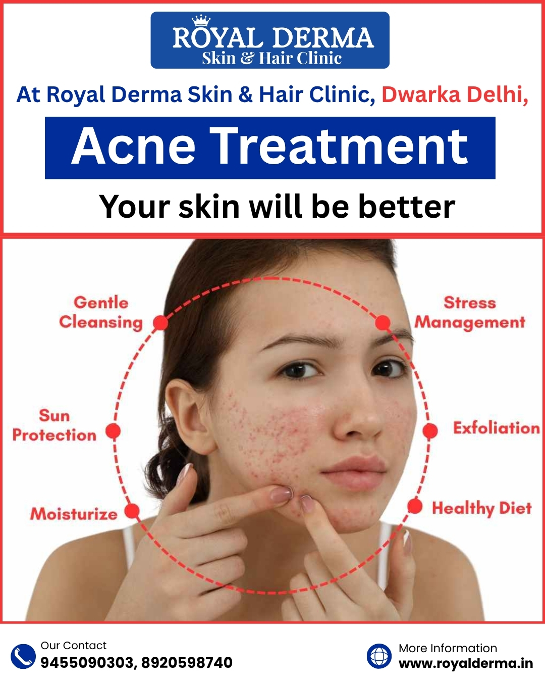 Say goodbye to stubborn acne!