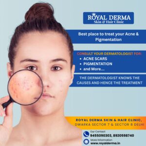 Say Goodbye to Acne & Pigmentation with Expert Dermatology Care at Royal Derma