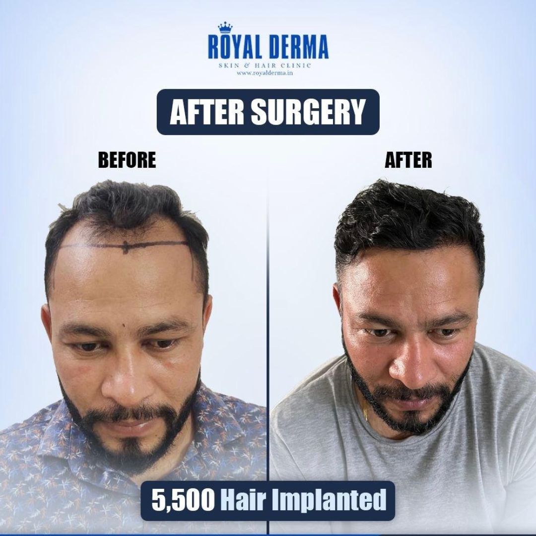 5500 grafts hair transplant result in Delhi