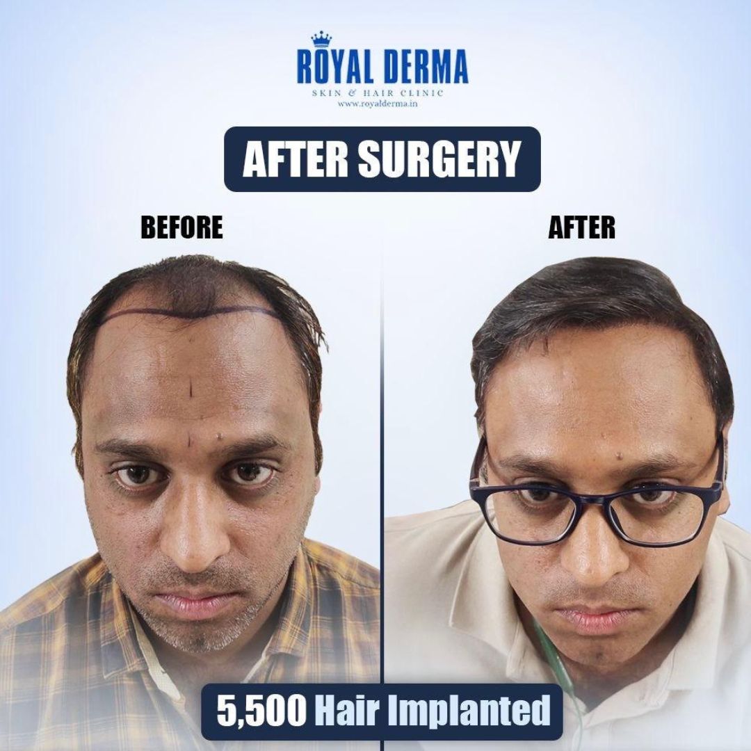 Before after hair restoration treatment Delhi