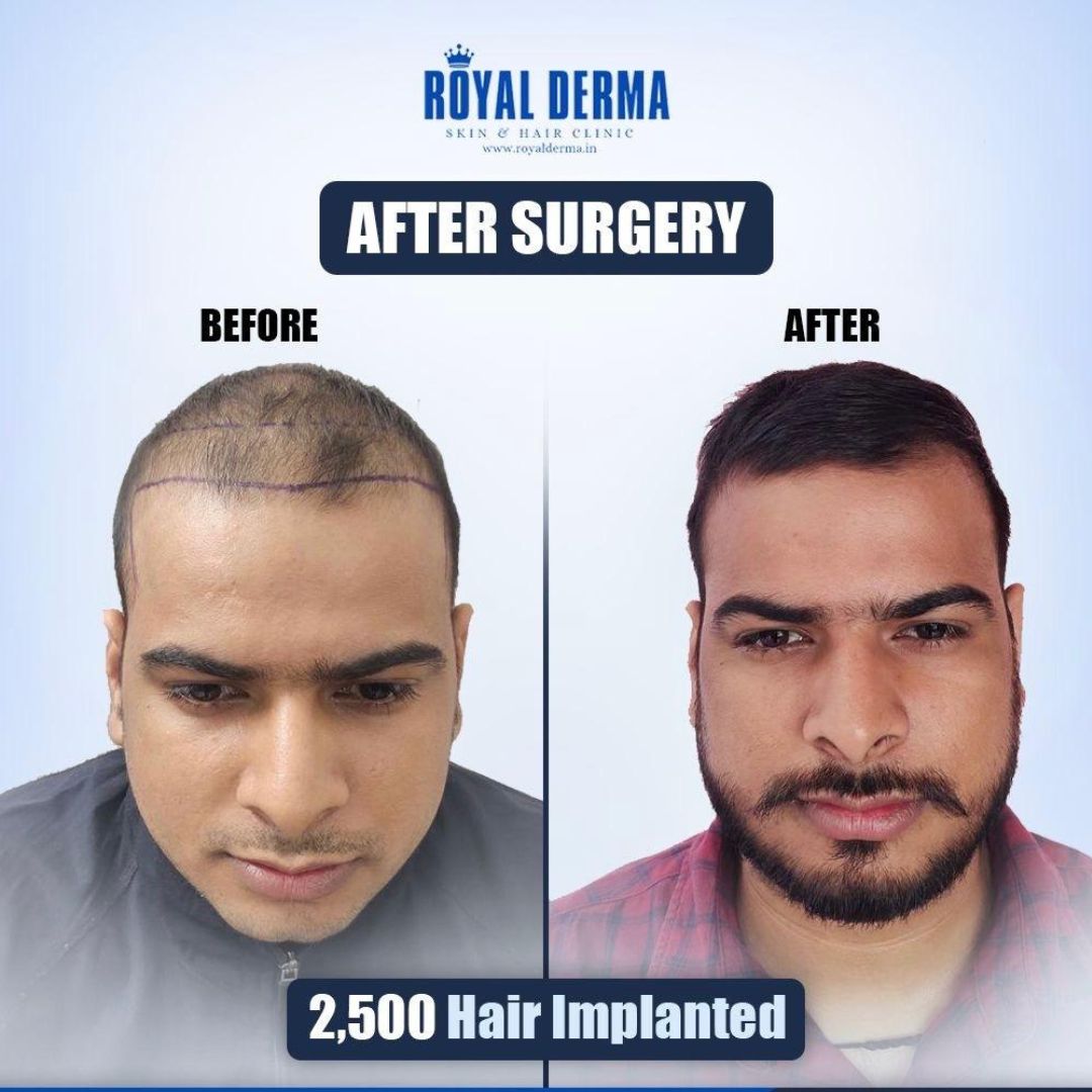 Hair transplant transformation Dwarka Delhi