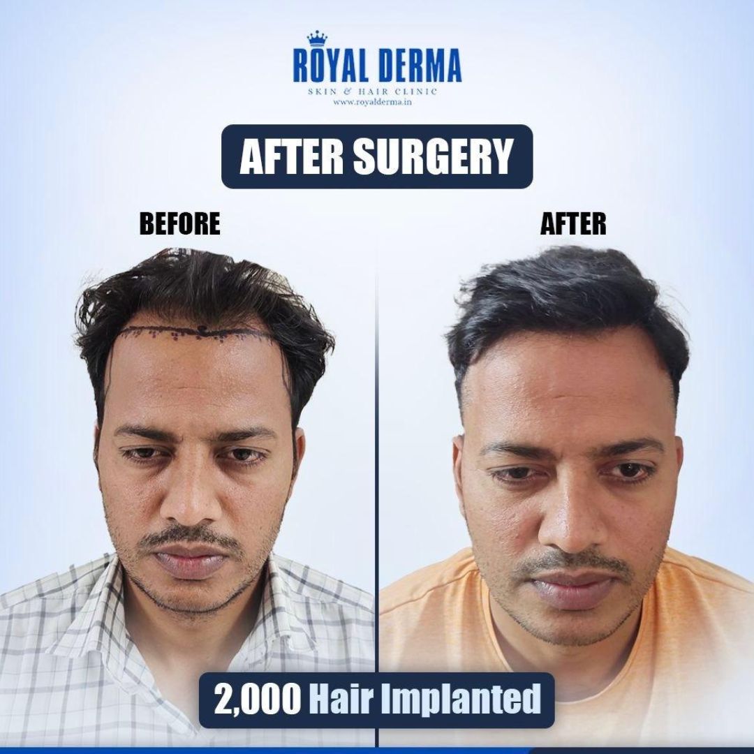 FUE hair transplant result Delhi